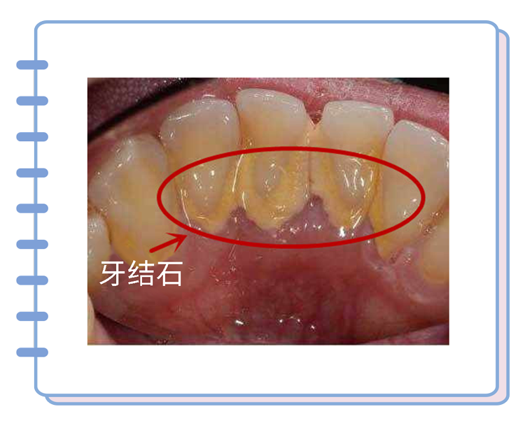 牙签断在手机取卡孔里怎么取出来(牙签枪两步做完简单教程)