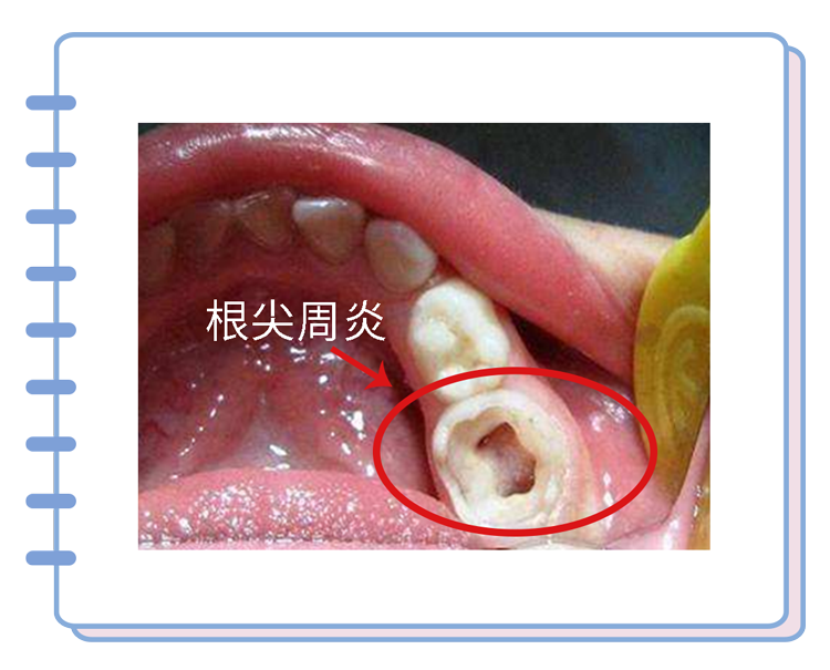 牙签断在手机取卡孔里怎么取出来(牙签枪两步做完简单教程)